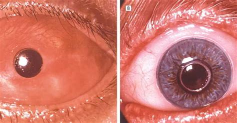 Implante De Dente No Olho - Oftalmologia - Cirurgia dente-no-olho: entenda procedimento - Universo ...