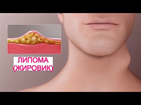 Липома - Arimed