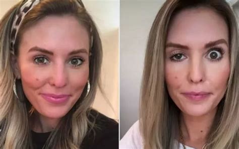 Onfaloplastia Antes E Depois