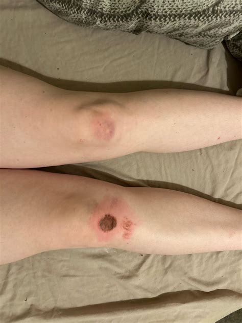 Anyone tell me if they think I might of fractured the knee with the