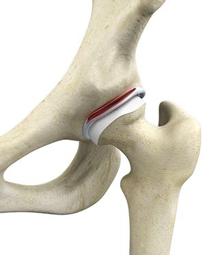 Hip Labral Tears Treatment Chicago, IL | Hip Impingement & Instability Chicago, IL