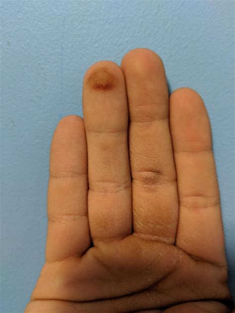 Callus From Engagement Ring at Patricia Bouchard blog