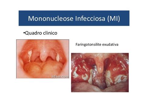 O Que E Mononucleose - Mononucleose Infecciosa