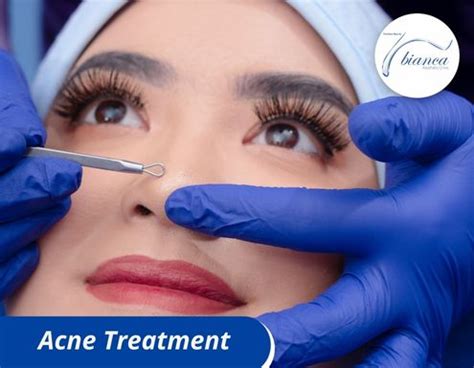 acne treatment bianca aesthetic clinic