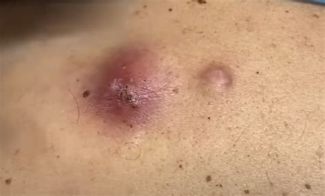 Infected Cysts Incision and Drainage - New Pimple Popping Videos