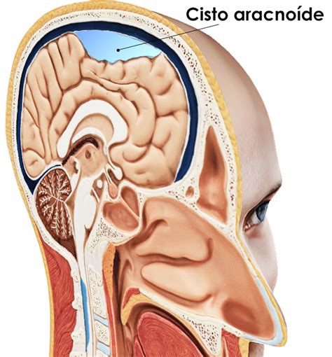 O Que É Um Cisto Na Cabeça - cisto aracnóide o que é, sintomas, causas e tratamento ? | Cisto Aracnoide