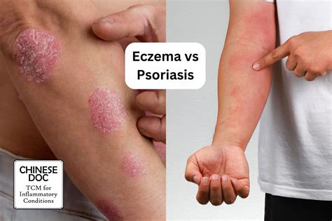 TCM Psoriasis Treatment - 1 Effective Method You Should Not Rule Out