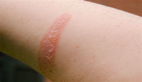 degree burn     treatment healing