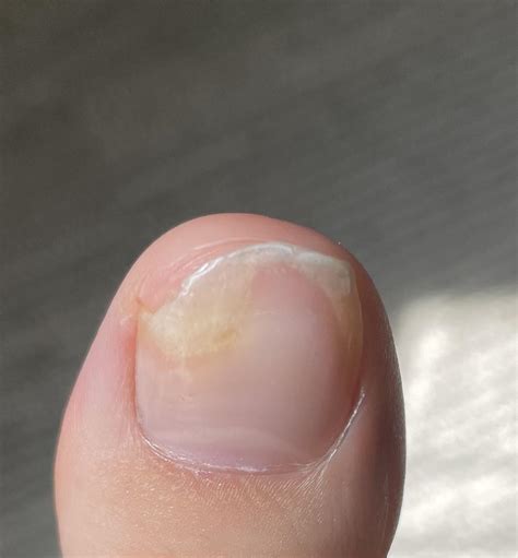nail fungus  noticed  rnailfungus