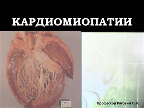 Кардиомиопатии. Классификация. Вовлечение миокарда - презентация онлайн