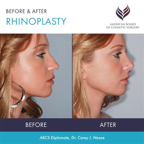 rhinoplasty surgery     types  rhinoplasty