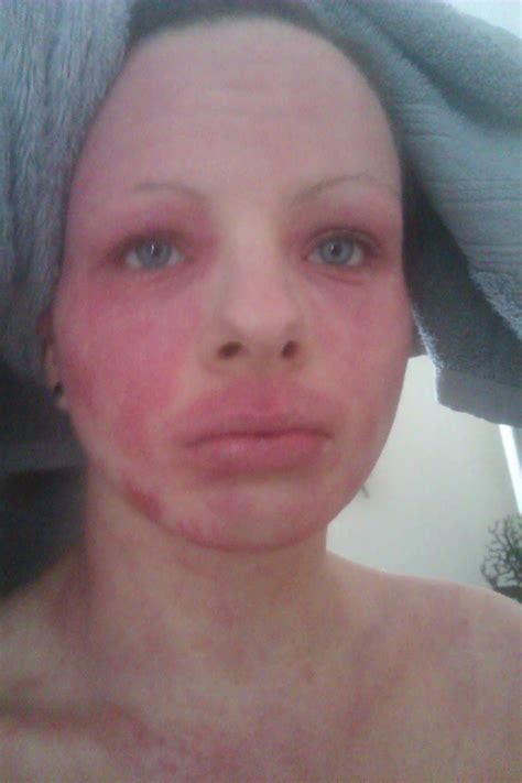 Redness Around Nose And Cheeks