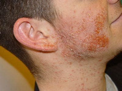 Staphylococcus aureus: jeho příznaky a léčba