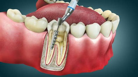 types  dental restorative procedures     sundance