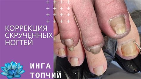 Вросший ноготь. Коррекция скрученных ногтей. - YouTube