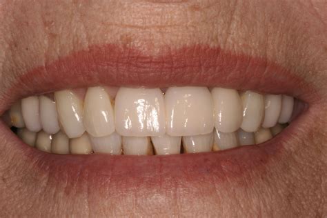 The Peak of Dentistry | The Peak of Dentistry | Whitening and Teeth