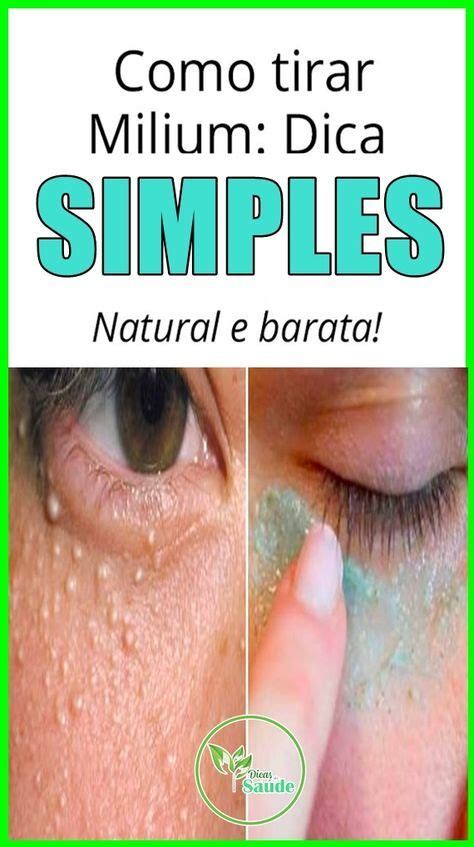 Como Remover Milium Do Rosto - Como Tirar Milium Do Rosto Em Casa – Seguro, Fácil E Sem | Bolinhas no ...