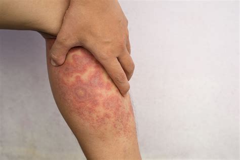 severe eczema definition symptoms  diagnosis treatment