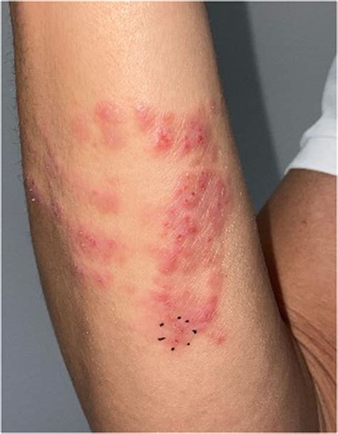 Jellyfish Sting Rash