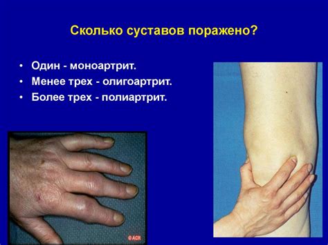 Суставной синдром в практике участкового терапевта - презентация онлайн