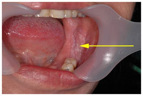 White Spots In Mouth Treatment - Infoupdate.org