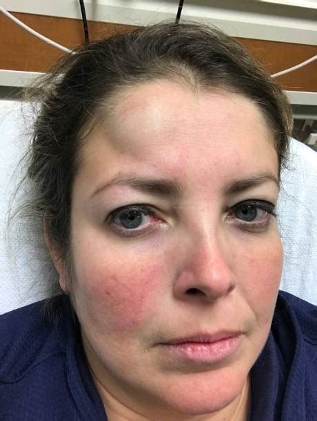 Bump On Head Stock Photos, Pictures & Royalty-Free Images - iStock