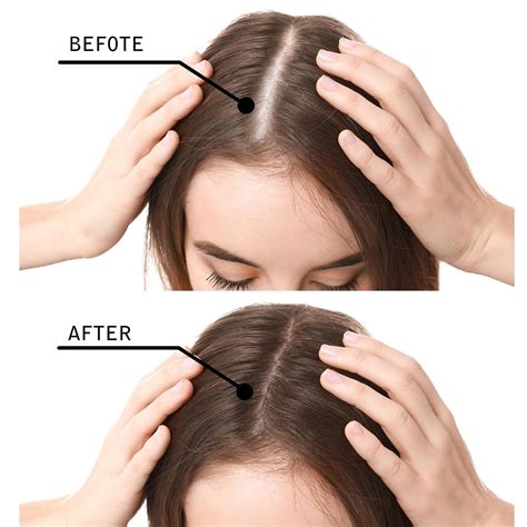 Home Remedies To Prevent Balding Thinning Hair, 60% OFF