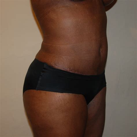 Mommy Makeover Before and After Galleries - Trinidad Institute of