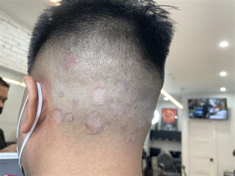 Ringworm On Scalp