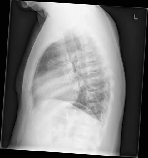 Sickle-cell disease x ray - wikidoc