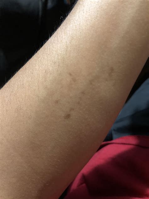 White Spots On Both Arms at Everett Hennis blog