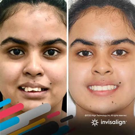 Imagine what Invisalign treatment can do for your smile