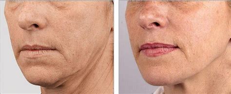 Teoxane Teosyal Redensity II Skin booster