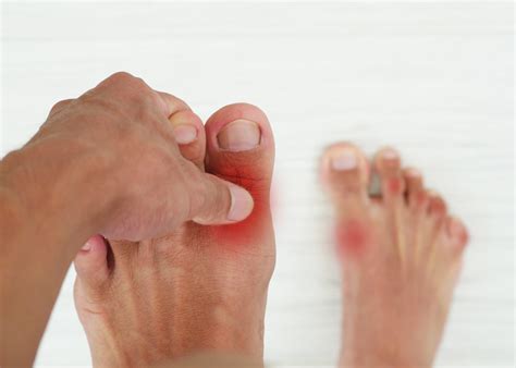 Gout Relief | Gout Shield Australia