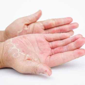 Contact Dermatitis - Allergy Testing Center