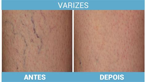 Laser Para Varizes Antes E Depois - Tratamento De Varizes Antes E Depois Benefícios Do Tratamento De