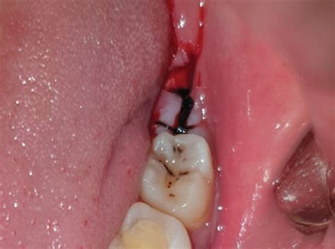 wisdom teeth stitches  complete guide  healing removal  aftercare