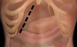 left subcostal incision