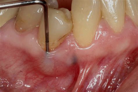 Visual Guide to Tooth Abscess Stages: Pictures, Symptoms, and Treatment