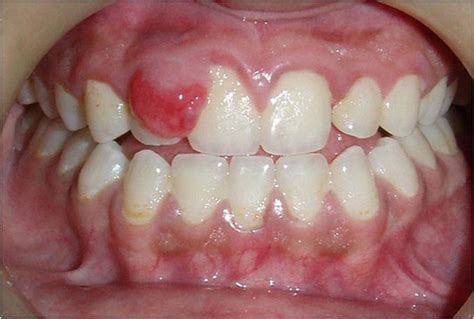 Peripheral Ossifying Fibroma – Exodontia