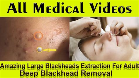 Experts Warn: This Unbelievable Blackhead Removal 2024 Trend is Dangerous! - q7woyr7