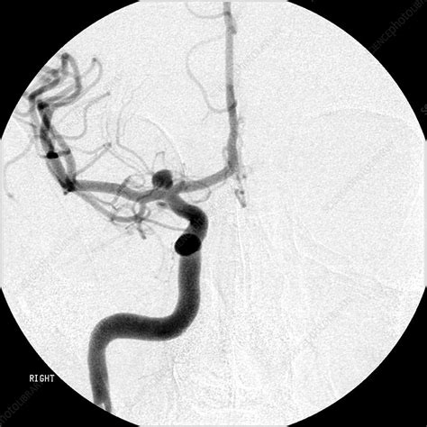cerebral angiogram  aneurysm stock image  science