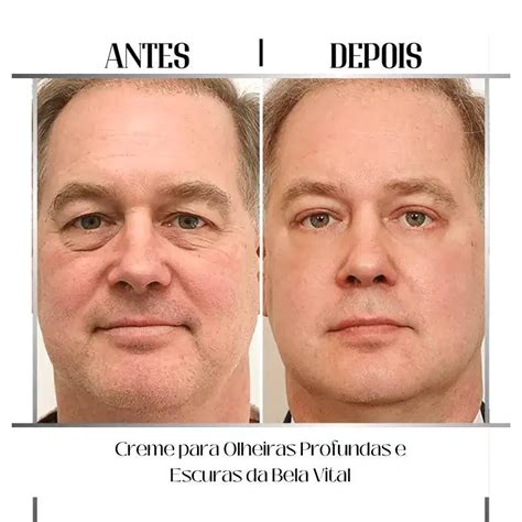 Creme Para Olheiras Escuras E Profundas - Efeitos do Creme para Olheiras Profundas e Escuras da Bela Vital