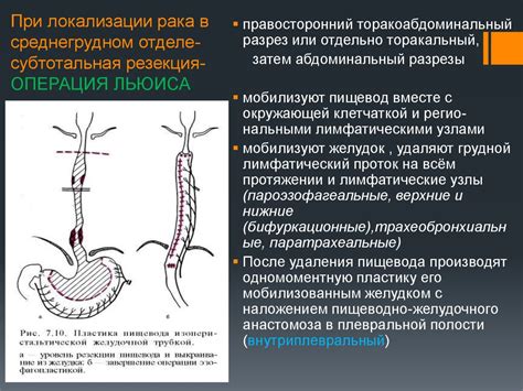 Оперативное лечение рака пищевода - презентация онлайн