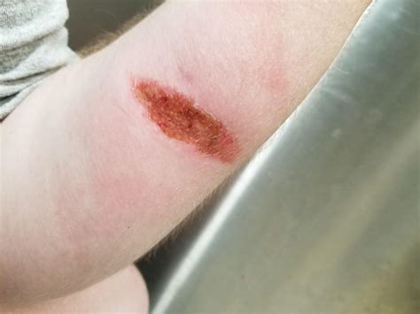 burn  days    infected medical