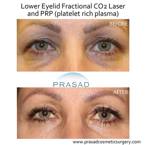 eye treatment