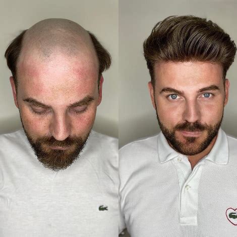 toupee   toupee    question