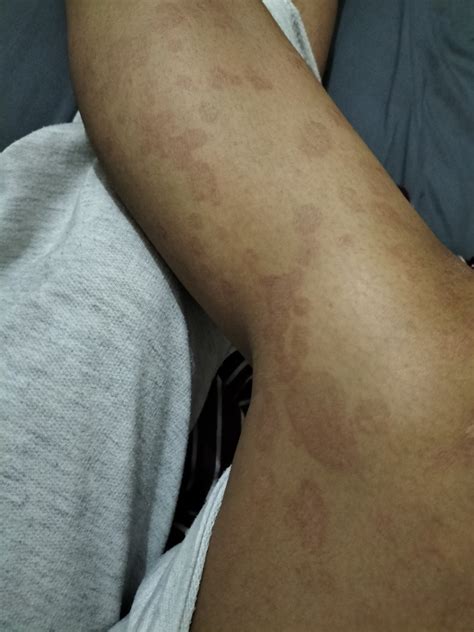 jamur  gejala autoimun hellosehat