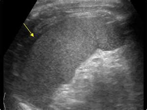 Abdomen and retroperitoneum | 1.4 Spleen : Case 1.4.7 Trauma of the ...