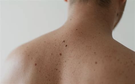 Medical and Cosmetic Dermatology in Salt Lake City - Salt Lake ...